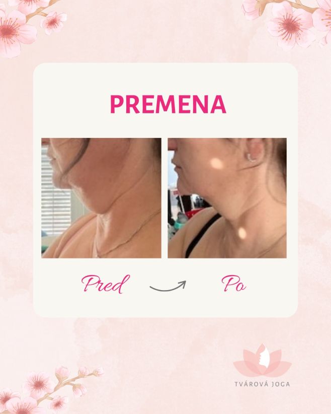 Trápi vás dvojitá brada a premýšľate, ako ju prirodzene zmenšiť? 🌸 Pozrite sa na úžasnú premenu mojej klientky po...